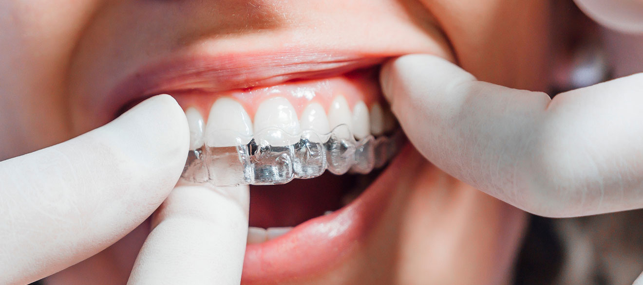 Close-up of Invisalign clear aligner being placed on teeth during treatment at Murias Dental